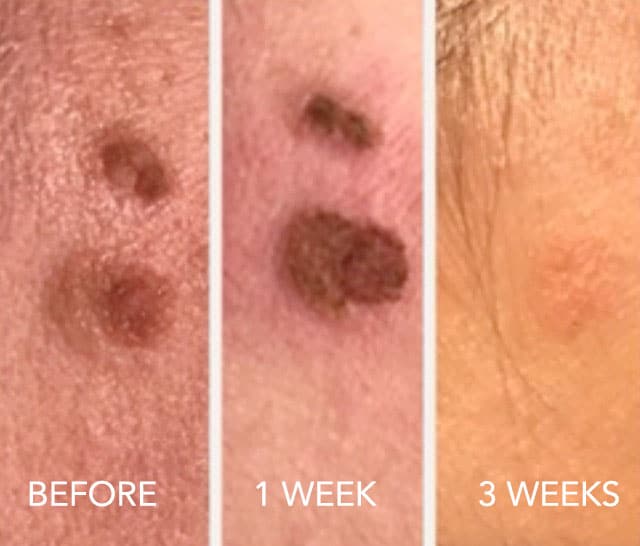 Before and After Cherry Angioma Treatment
